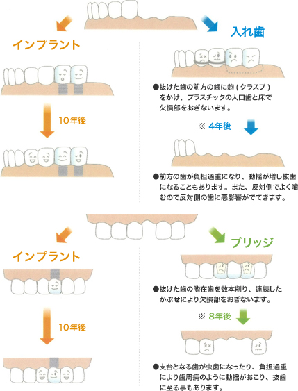 インプラント 入れ歯 ●抜けた歯の前方の歯に鉤(スクラブ)
　をかけ、プラスチックの人口歯と床で
　欠損部をおぎないます。 10年後 ※ 4年後 ●前方の歯が負担過重になり、動揺が増し抜歯
　になることもあります。また、反対側でよく噛
　むので反対側の歯に悪影響がでてきます。インプラント ブリッジ ●抜けた歯の隣在歯を数本削り、連続した
　かぶせにより欠損部をおぎないます。10年後 ※ 8年後 ●支台となる歯が虫歯になったり、負担過重
　により歯周病のように動揺がおこり、抜歯
　に至る事もあります。