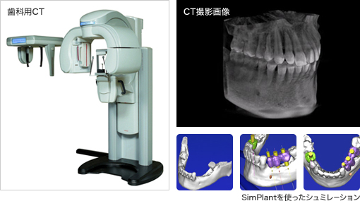 歯科用CT CT撮影画像 SimPlantを使ったシュミレーション