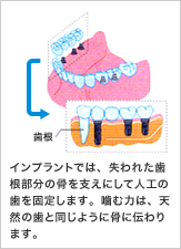 歯根 インプラントでは、失われた歯根部分の骨を支えにして人工の歯を固定します。噛む力は、天然の歯と同じように骨に伝わります。