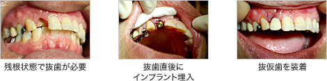 残根状態で抜歯が必要  抜歯直後にインプラント埋入  抜仮歯を装着